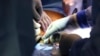 First patient to get gene-edited pig kidney transplant dies 